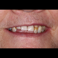 Dental Bridges - Smile 1 before